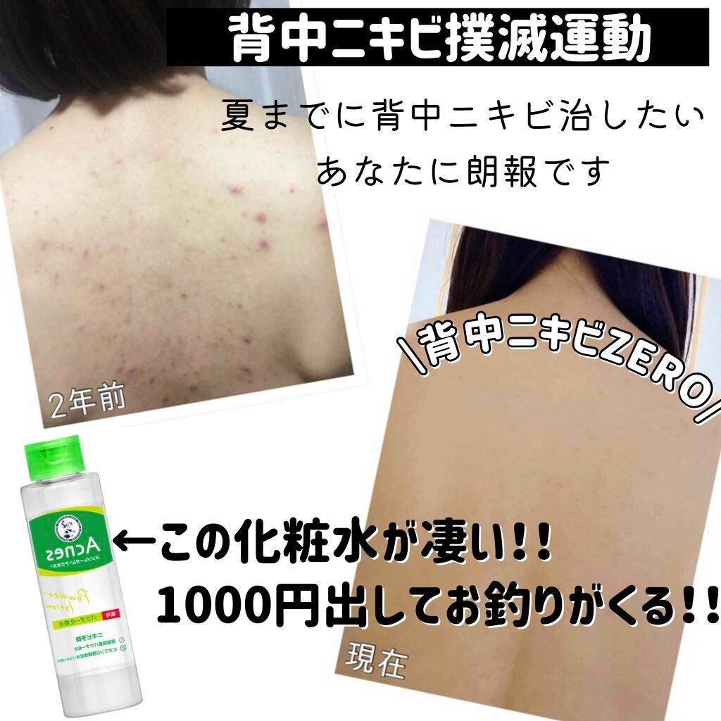 薬用パウダー化粧水/メンソレータム アクネス/化粧水を使ったクチコミ(1枚目)