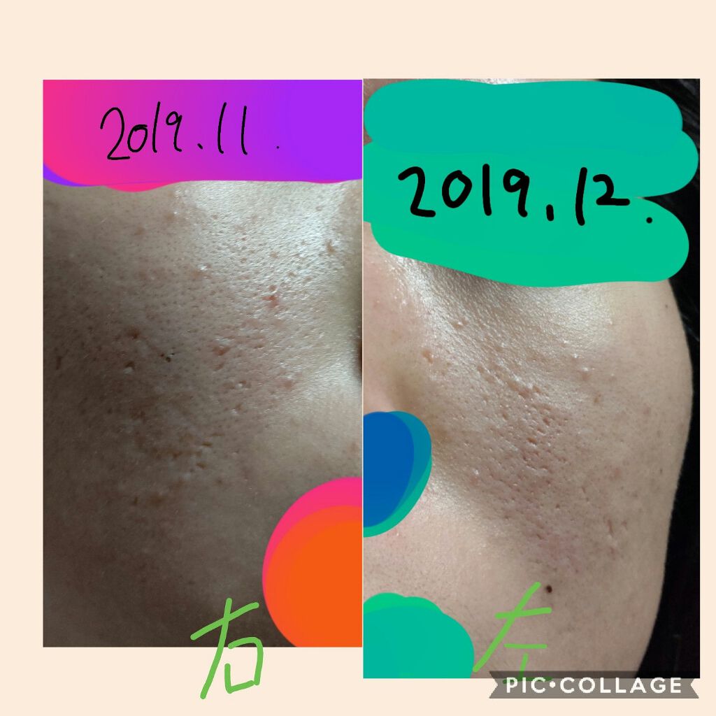 スマートセット/プロアクティブ/スキンケアキットを使ったクチコミ(2枚目)