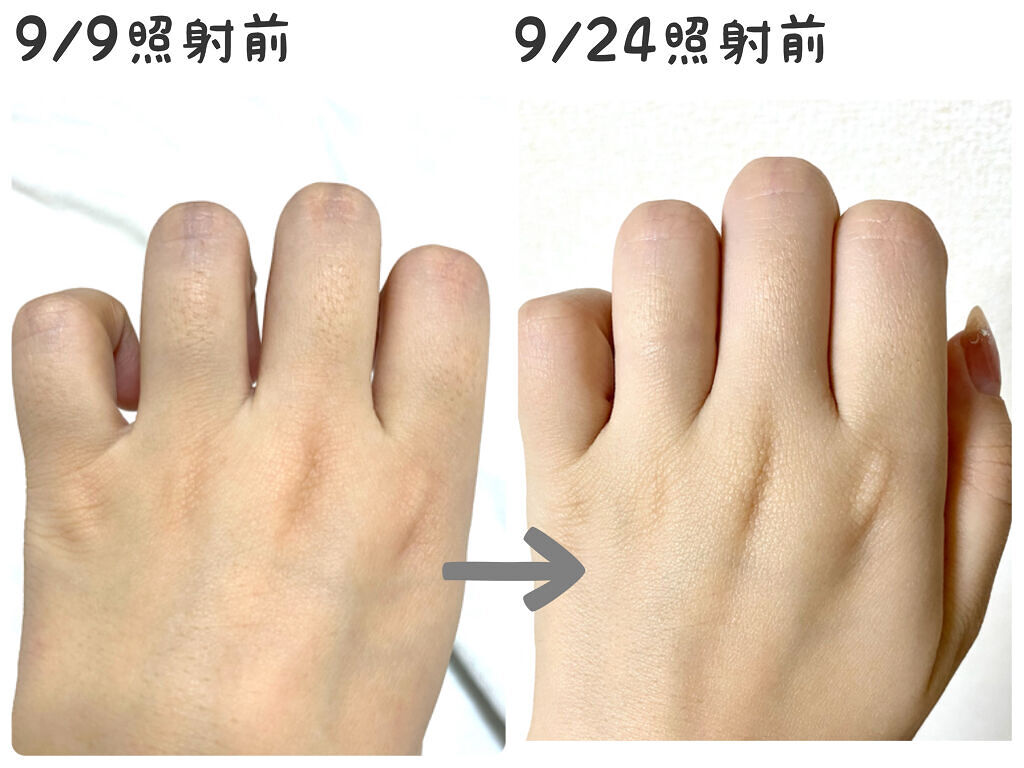 アイスレディ/icelady/家庭用脱毛器を使ったクチコミ（2枚目）