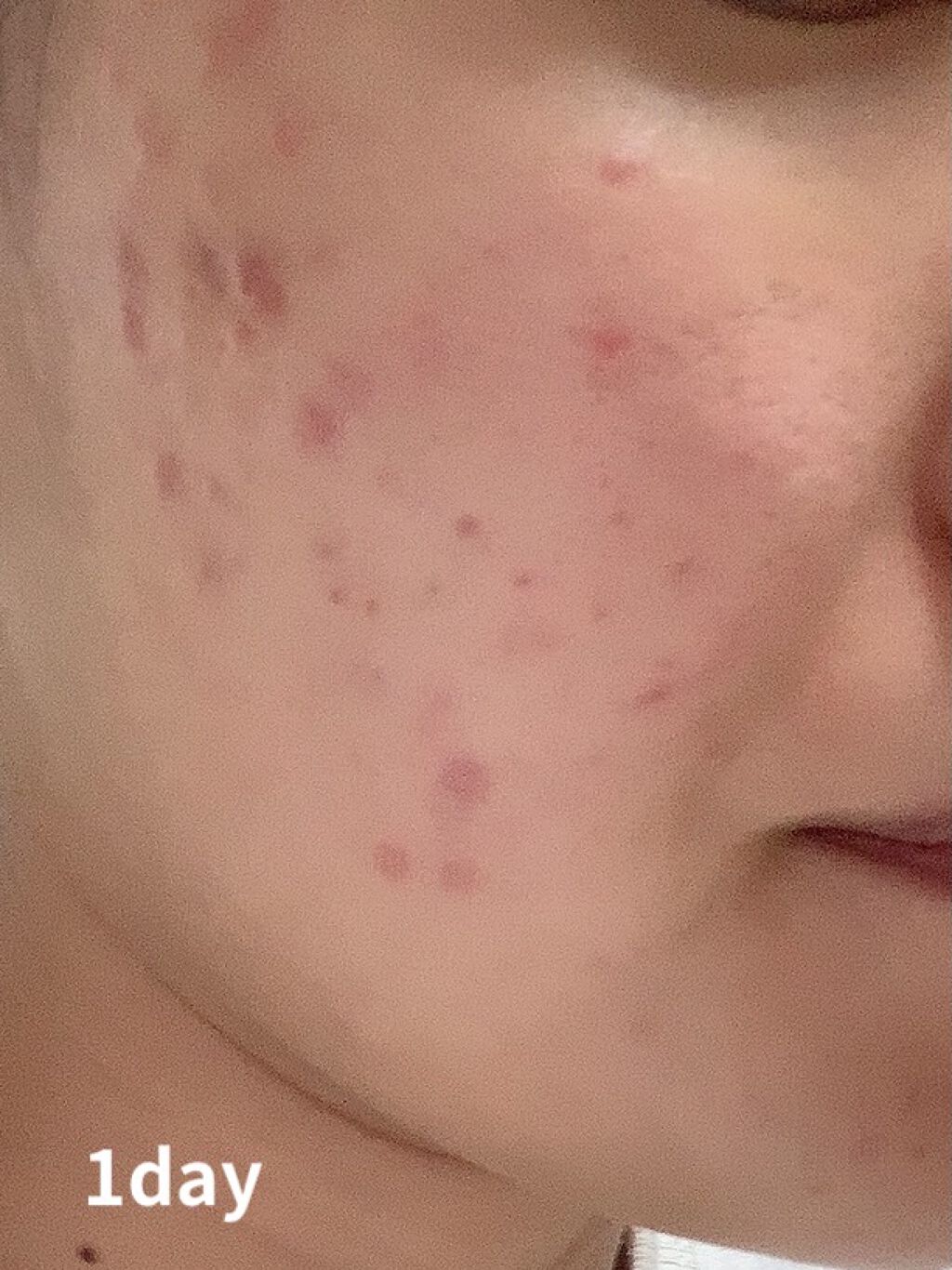 アクアチムローション、アクアチムクリーム(医薬品)/大塚製薬/その他を使ったクチコミ（2枚目）