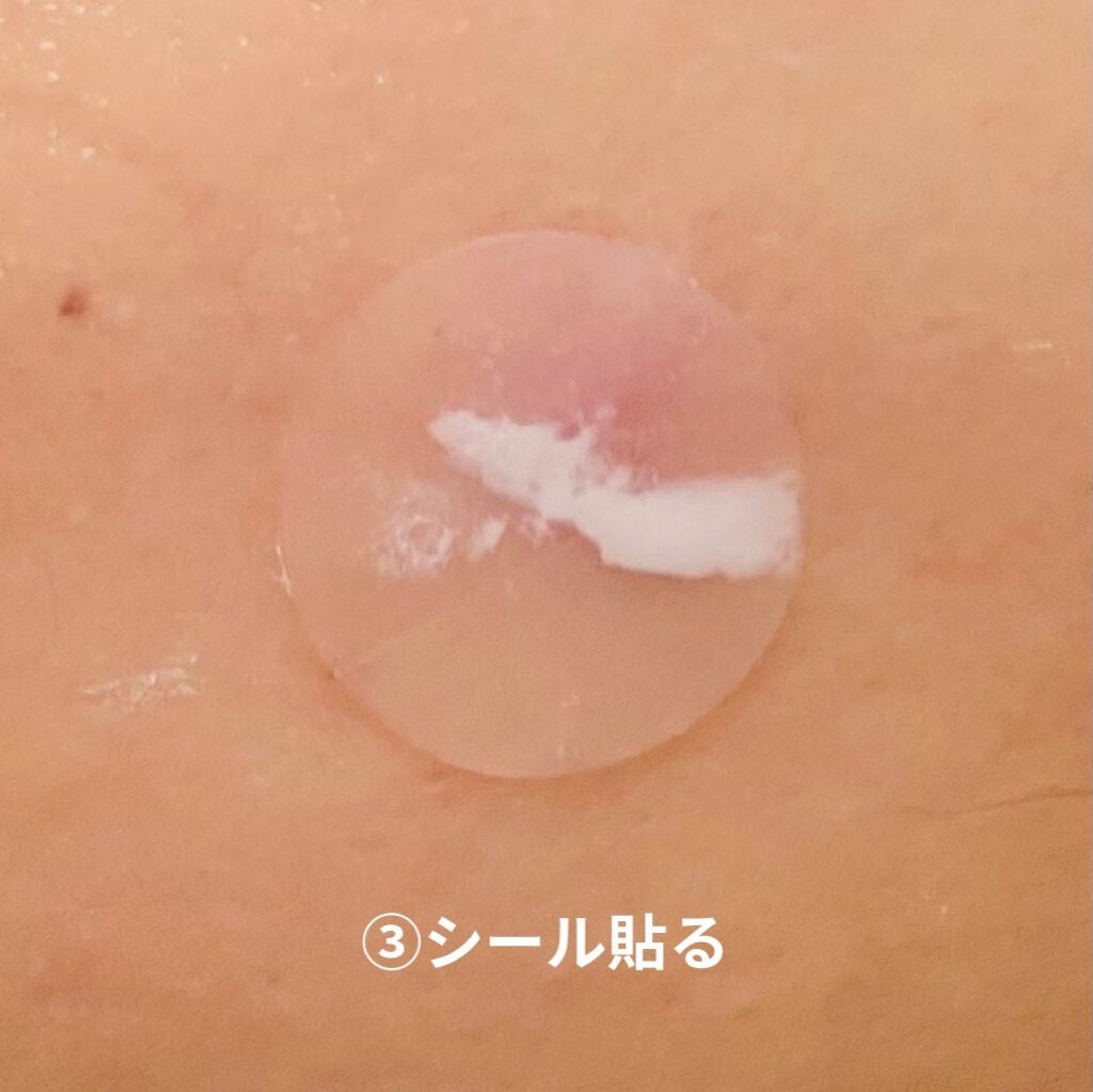 薬用ニキビケア スポッツクリーム/アクネスラボ/フェイスクリームを使ったクチコミ(7枚目)