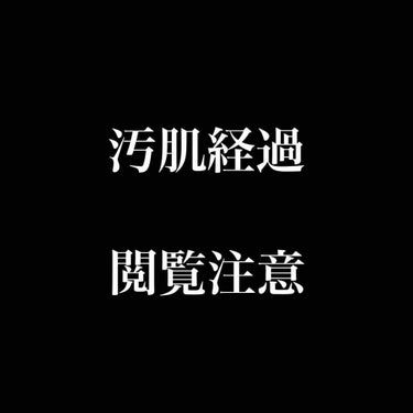 美顔 明色 美顔水 薬用化粧水のクチコミ「汚肌の経過です。
ノーマルカメラです。

5/5 Before
→5日後 5/8 After→.....」（1枚目）