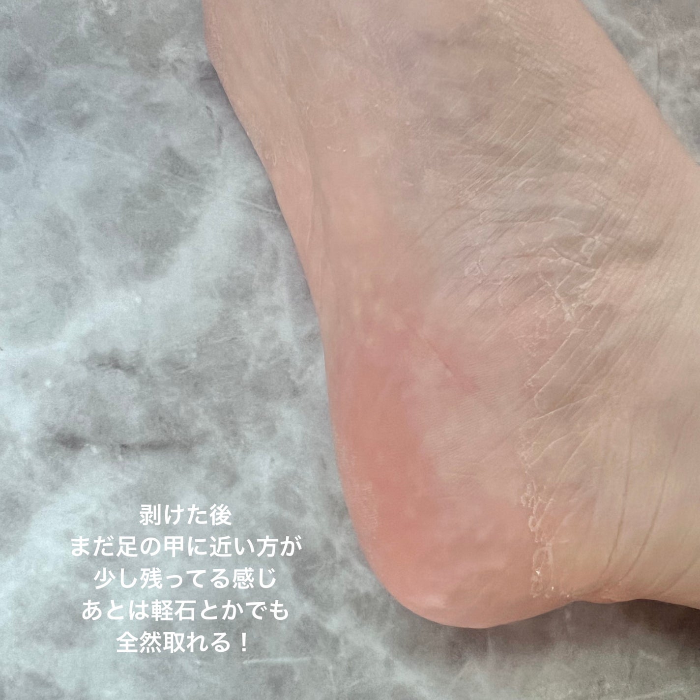 イージーパックDP60分タイプ/ベビーフット/レッグ・フットケアを使ったクチコミ(6枚目)