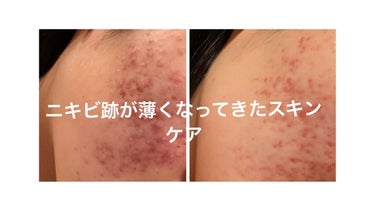 メラノCC 薬用しみ集中対策 プレミアム美容液のクチコミ「今回はニキビ跡が薄くなってきたスキンケアや、辞めたことなどを紹介したいと思います。
3ヶ月でゆ.....」（1枚目）