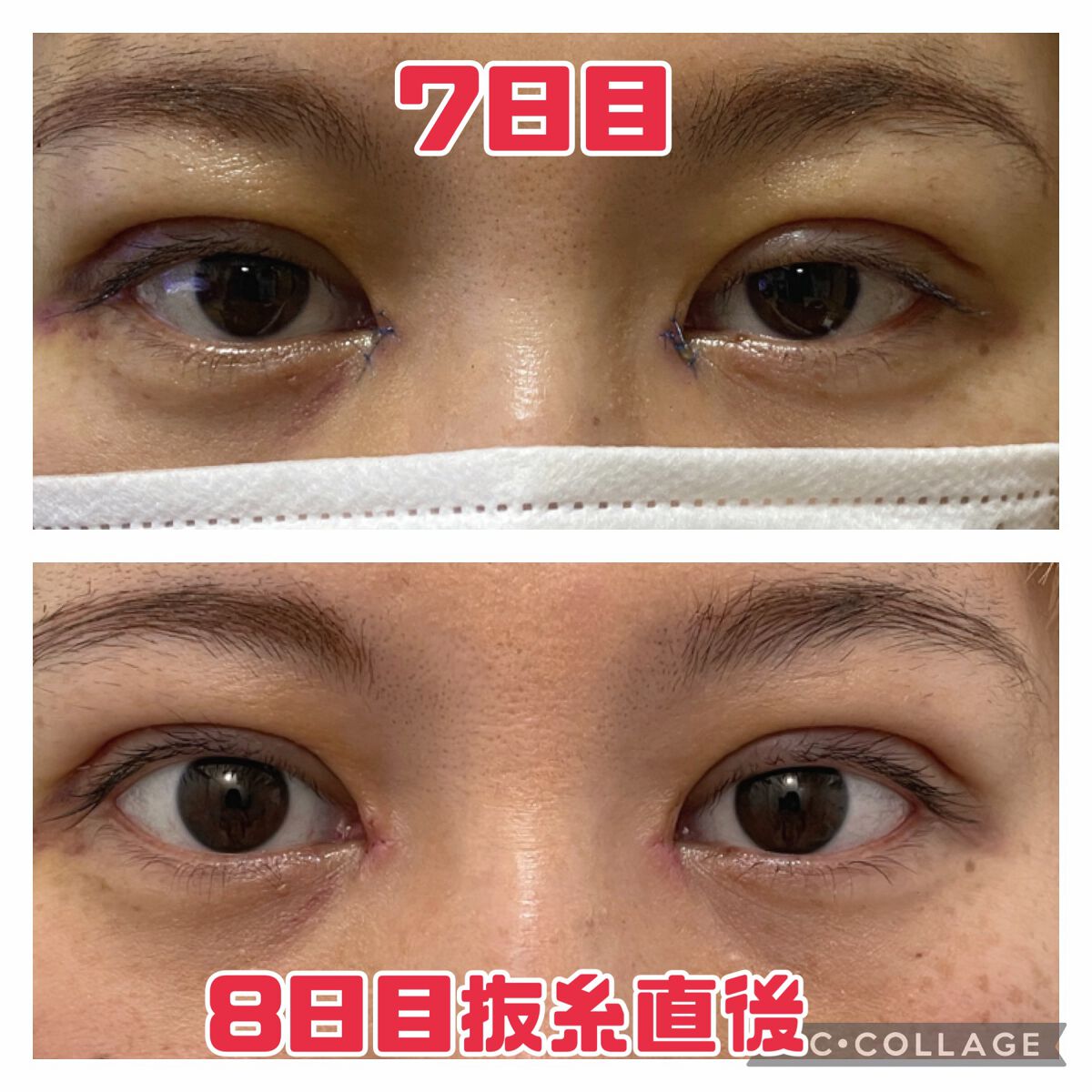 ふうせん @フォロバ100% on LIPS 「3月3日8日目抜糸の日抜糸直後なので少し赤みがあるかもしれない..」(1枚目)