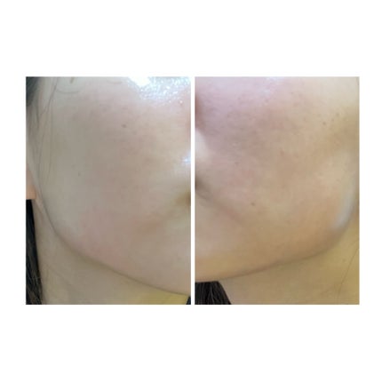 ぽむ on LIPS 「2023.9.13皮膚科に受診 エピデュオとヘパリン処方1枚目..」(4枚目)