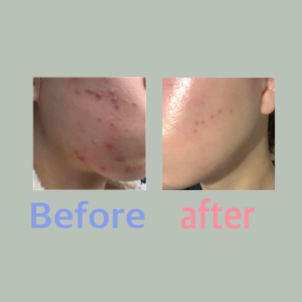 mochi on LIPS 「1つもニキビが出来なくなりました🎉このままキープしていきたいで..」(1枚目)