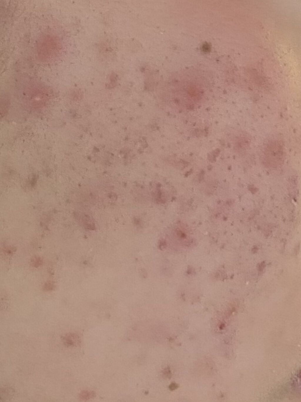 エピデュオゲル/美容皮膚科/フェイスクリームを使ったクチコミ（1枚目）