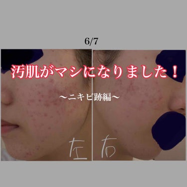 敏感肌用薬用美白美容液/無印良品/美容液を使ったクチコミ（1枚目）