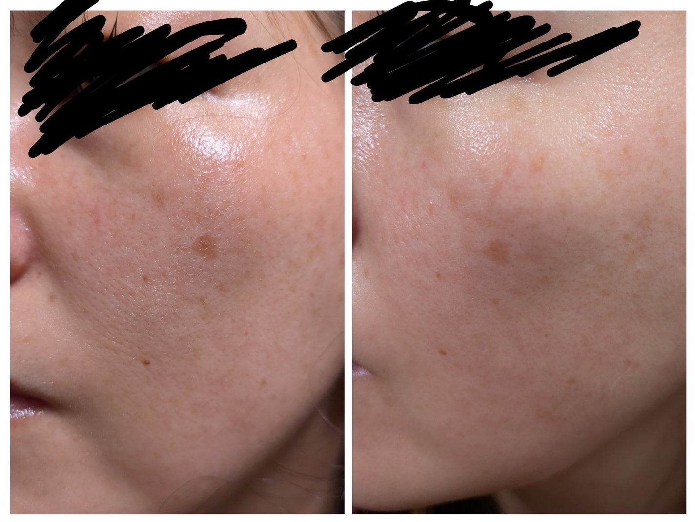 のぞみ on LIPS 「美容内服も初めて1ヶ月経過しましたー。左が内服始めた頃。右が1..」(1枚目)