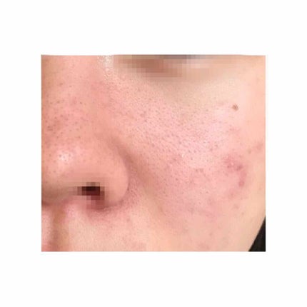 ayu on LIPS 「初めまして、高校2年の17歳です。悩み│毛穴の開き黒ずみ、ニキ..」(2枚目)