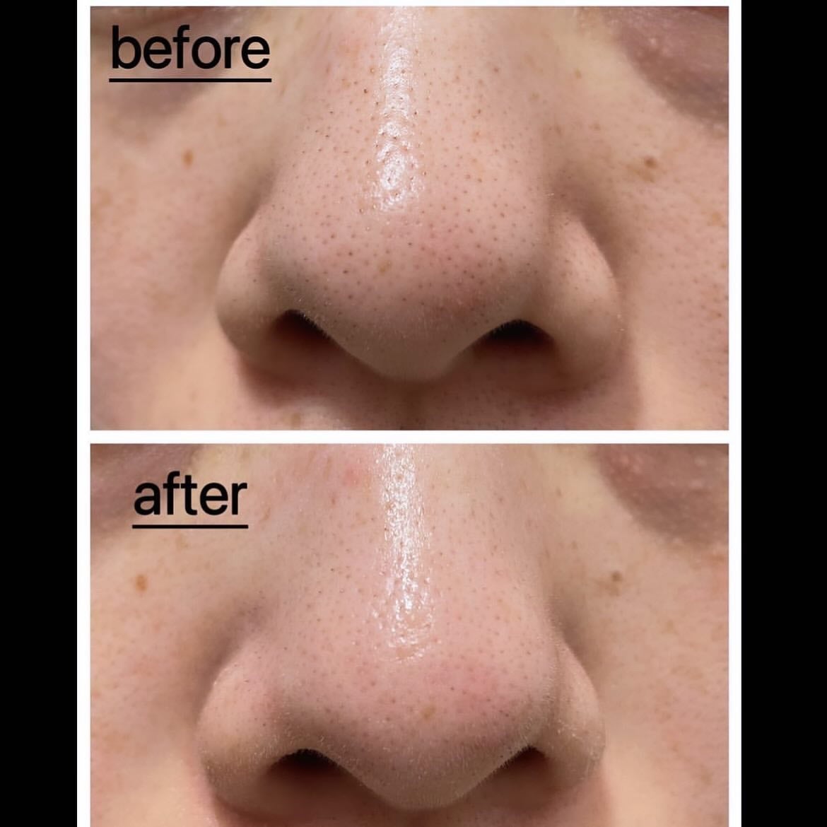 natsu on LIPS 「...超人気のクレンジングオイル@anua.jpさんの『ドクダ..」(2枚目)