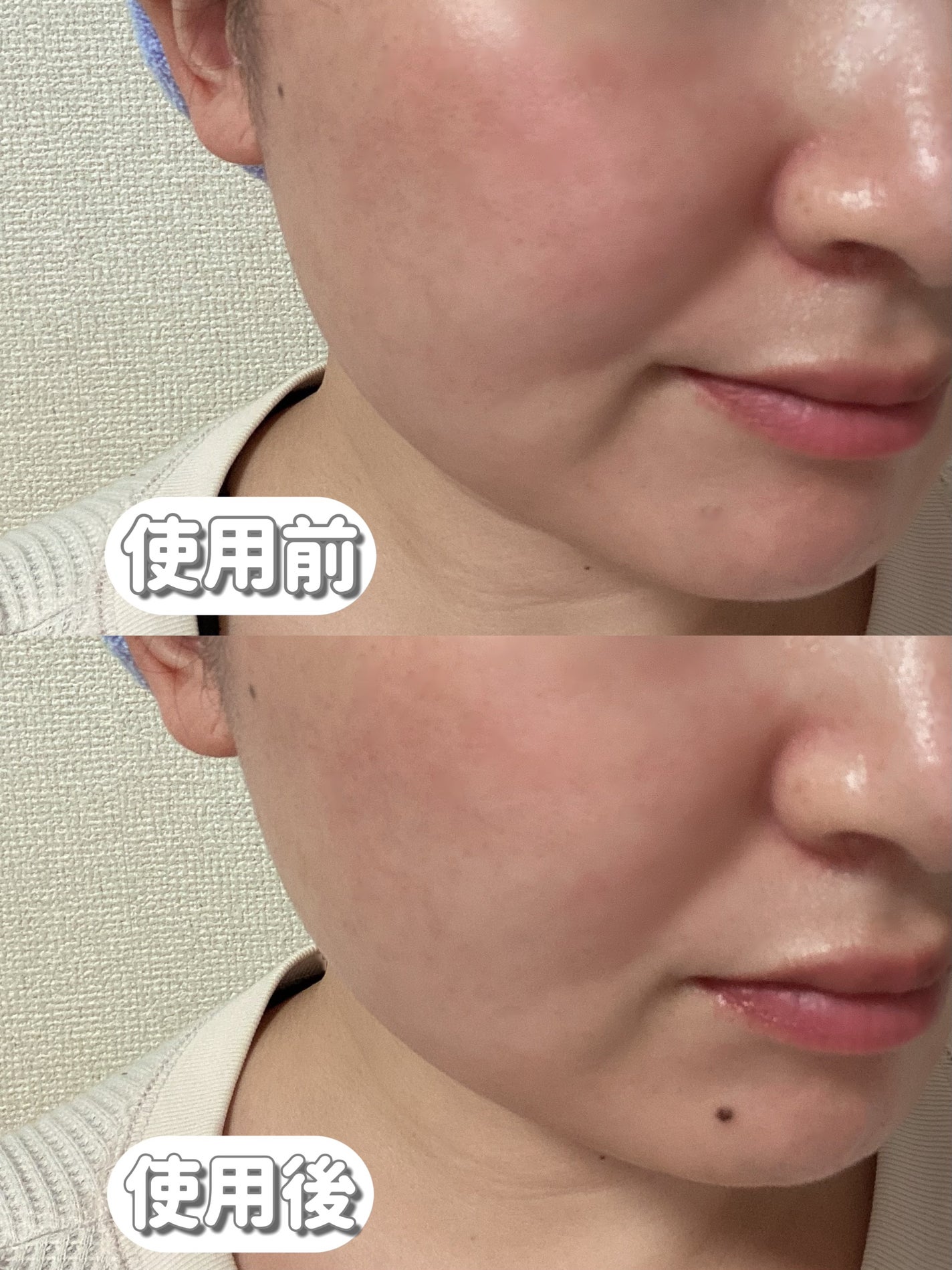 RF温冷美顔器PRO/ANLAN/美顔器・マッサージを使ったクチコミ(10枚目)