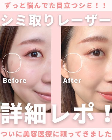 mii♡イエベ春🌸フェミニン on LIPS 「シミとりレーザー感想と経過をまとめました💁🏻‍♀️✨同じ悩みの..」（1枚目）