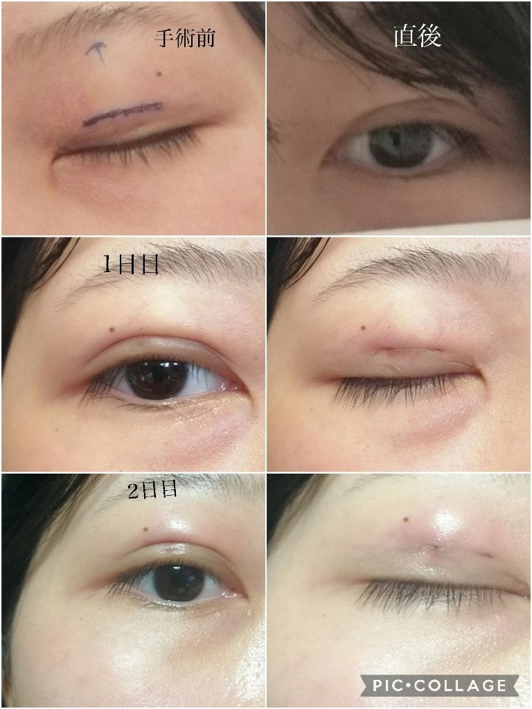 シンデレラCOMP👸💦 on LIPS 「⚠️閲覧注意⚠️埋没の糸が3ヶ月で取れました…。こんにちは、シ..」(5枚目)