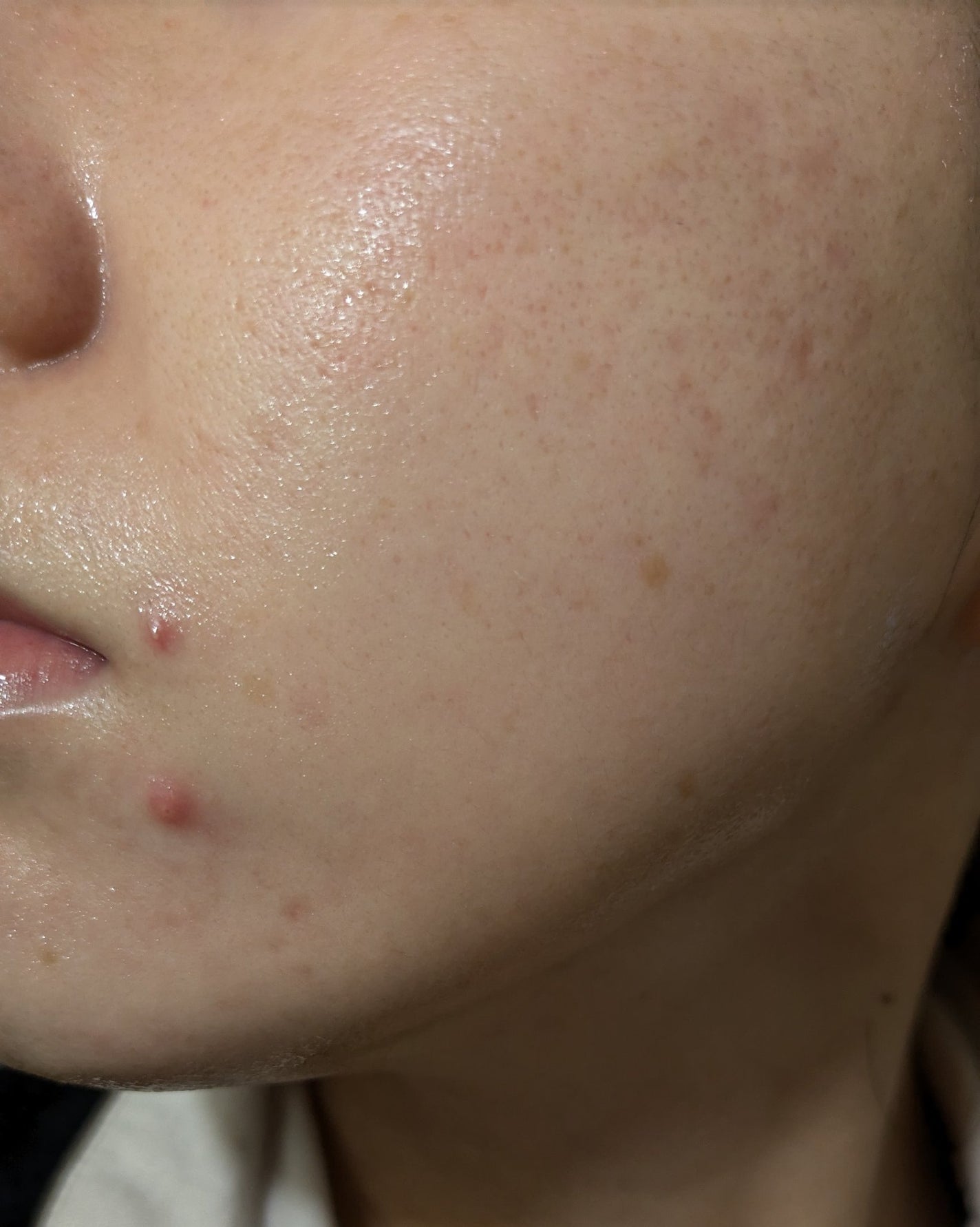 miina@汚肌工事録⚠️ on LIPS 「10/22の#汚肌工事録くま?も意外とありました😱💐肌がのため..」(2枚目)