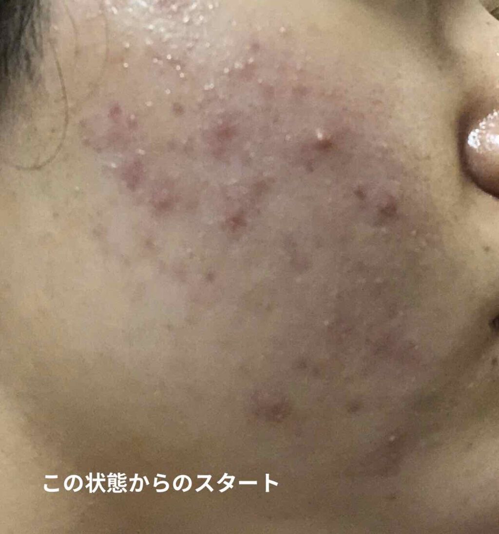 十味敗毒湯 ジュウミハイドクトウ(医薬品)/クラシエ薬品/その他を使ったクチコミ（2枚目）