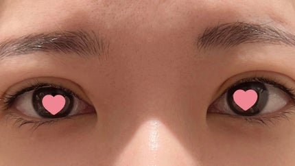 め@フォロバします on LIPS 「6/21追記二重全切開&脱脂の記録。2021年8月31日に受け..」(5枚目)