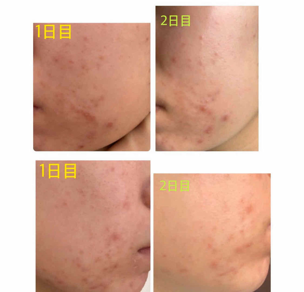 エピデュオゲル/マルホ株式会社/その他を使ったクチコミ（2枚目）