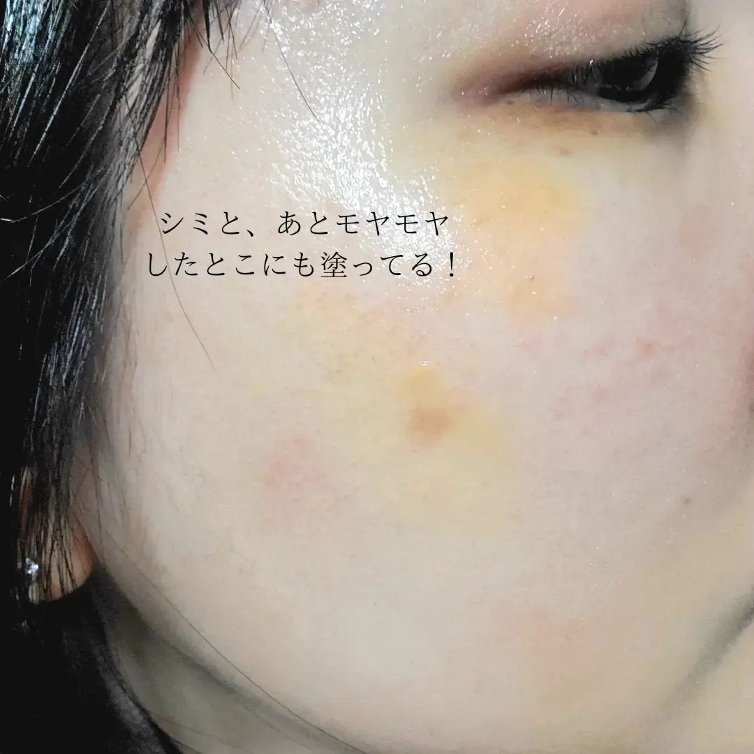 トラネキサム酸6%クリーム/DERMA FACTORY/フェイスクリームを使ったクチコミ(5枚目)