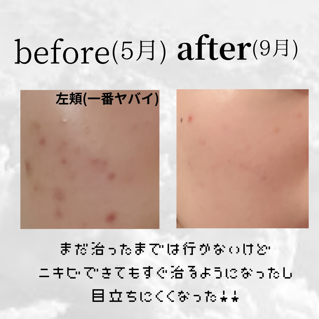 プロCICA クリアスポットパッチ/VT/その他スキンケアを使ったクチコミ（2枚目）