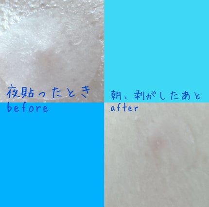 ごめんね素肌 キニシナイパッチ/クリアターン/シートマスク・パックを使ったクチコミ(2枚目)