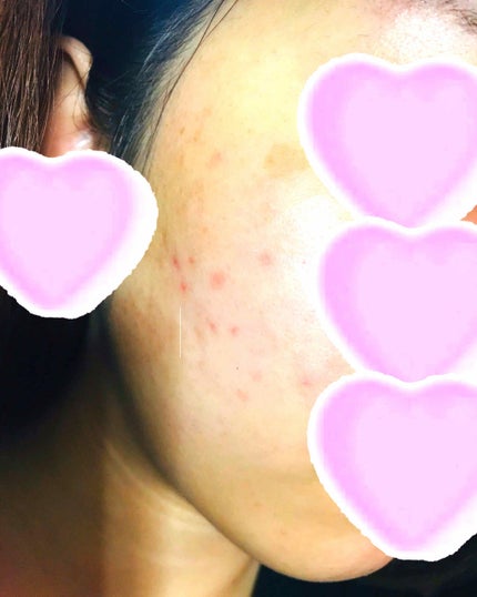 DHC はとむぎエキス/DHC/健康サプリメントを使ったクチコミ(2枚目)