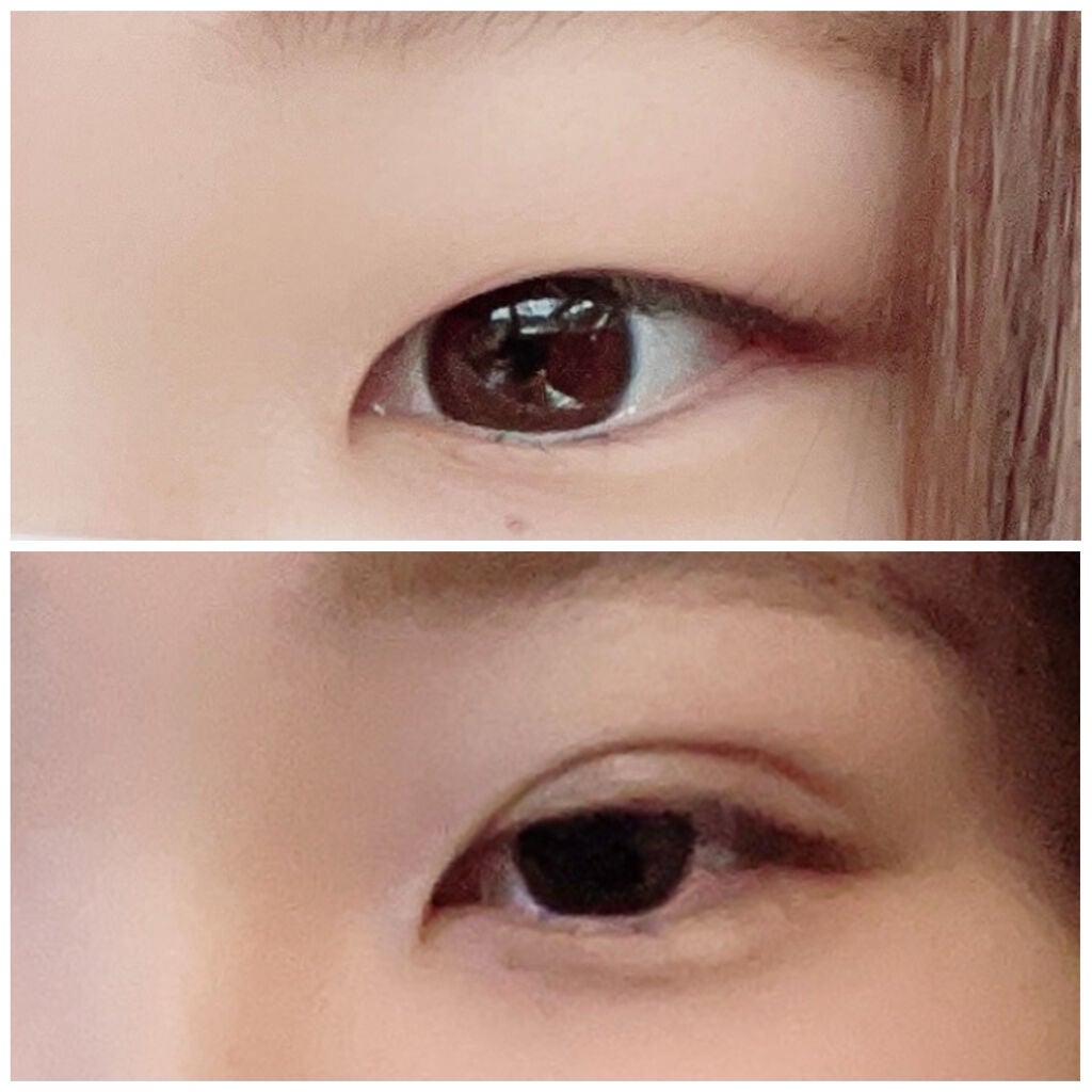 もも on LIPS 「【初投稿】埋没法記録自分用のメモとして投稿します1枚目上施術前..」(1枚目)