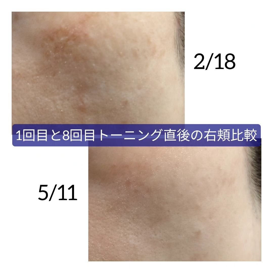 あにゃにゃ♡フォロバ100♡ on LIPS 「8回目トーニング&肝斑治療その4⚠2枚目、3枚目閲覧注意💣昨日..」(3枚目)