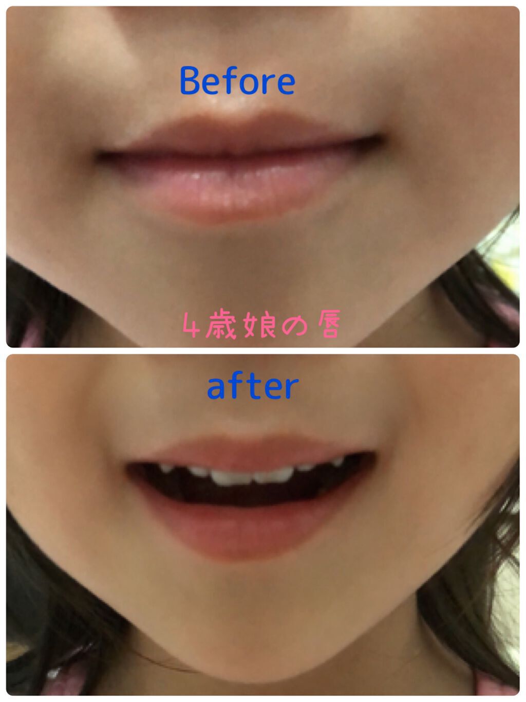 Lip Medex/Blistex/リップバームを使ったクチコミ(4枚目)