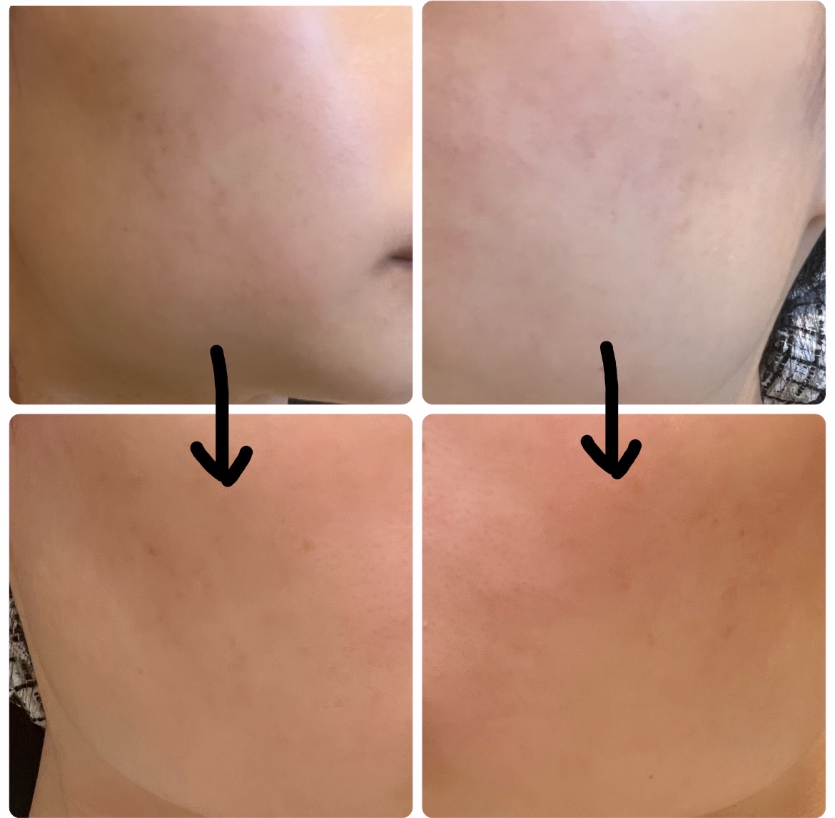 A アクネローション/NOV/化粧水を使ったクチコミ（2枚目）