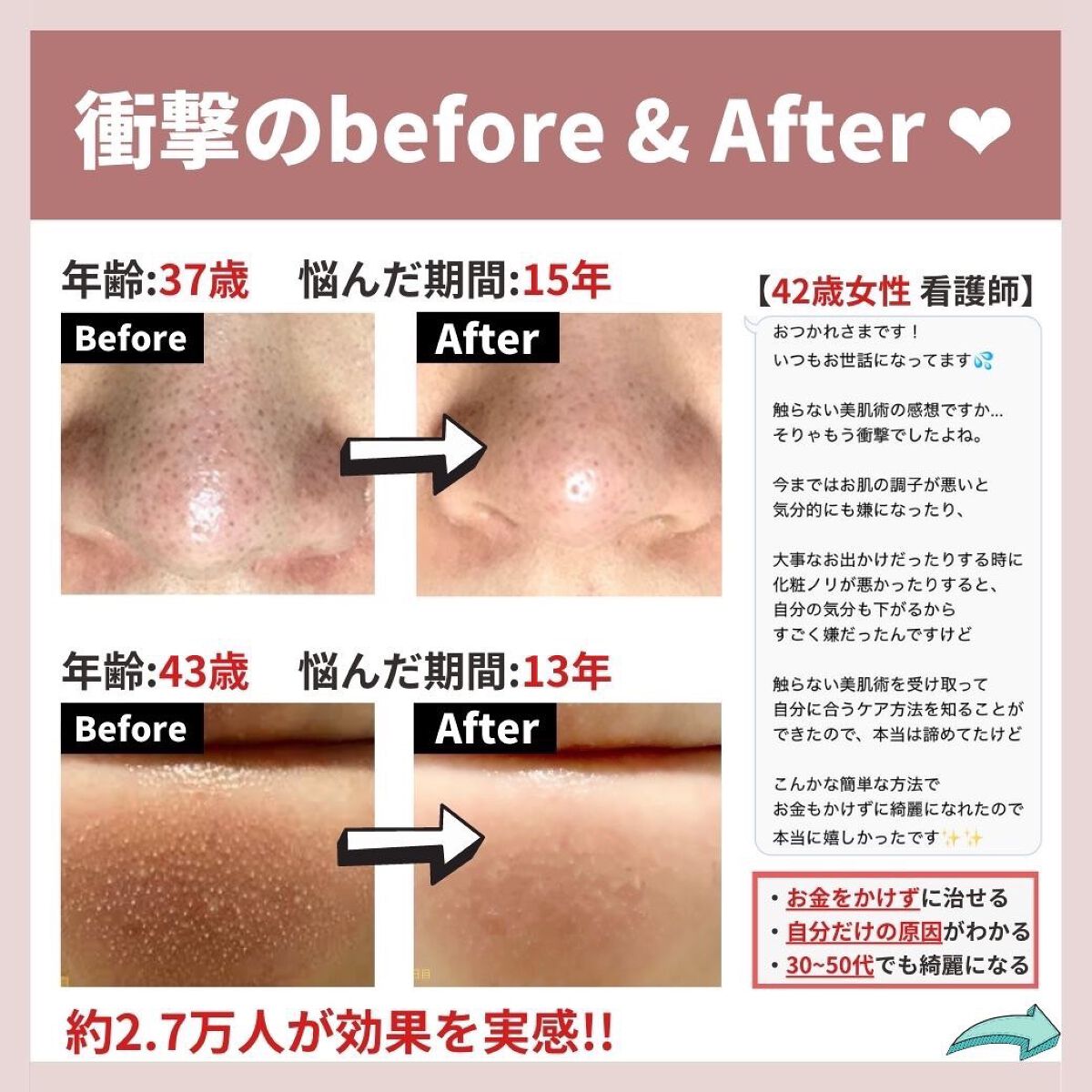 あなたの肌に合ったスキンケア💐コーくん先生 on LIPS 「【2.7万人が効果を実感✨】鼻の角栓3日で消す方法🤫..あなた..」(8枚目)