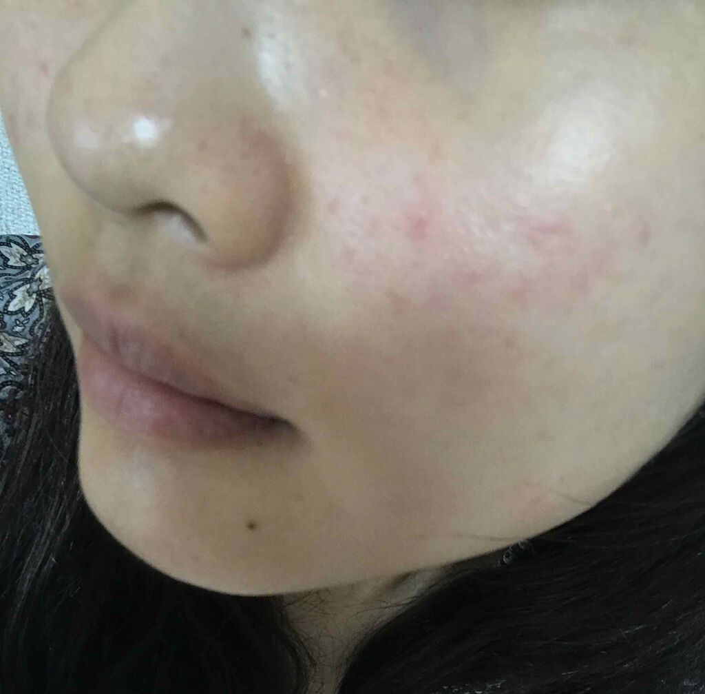 ペアアクネクリームW(医薬品)/ペア/その他を使ったクチコミ(2枚目)