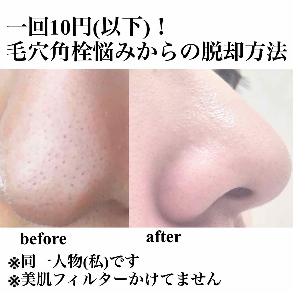 スキンピールバー ティートゥリー/サンソリット/洗顔石鹸を使ったクチコミ(1枚目)