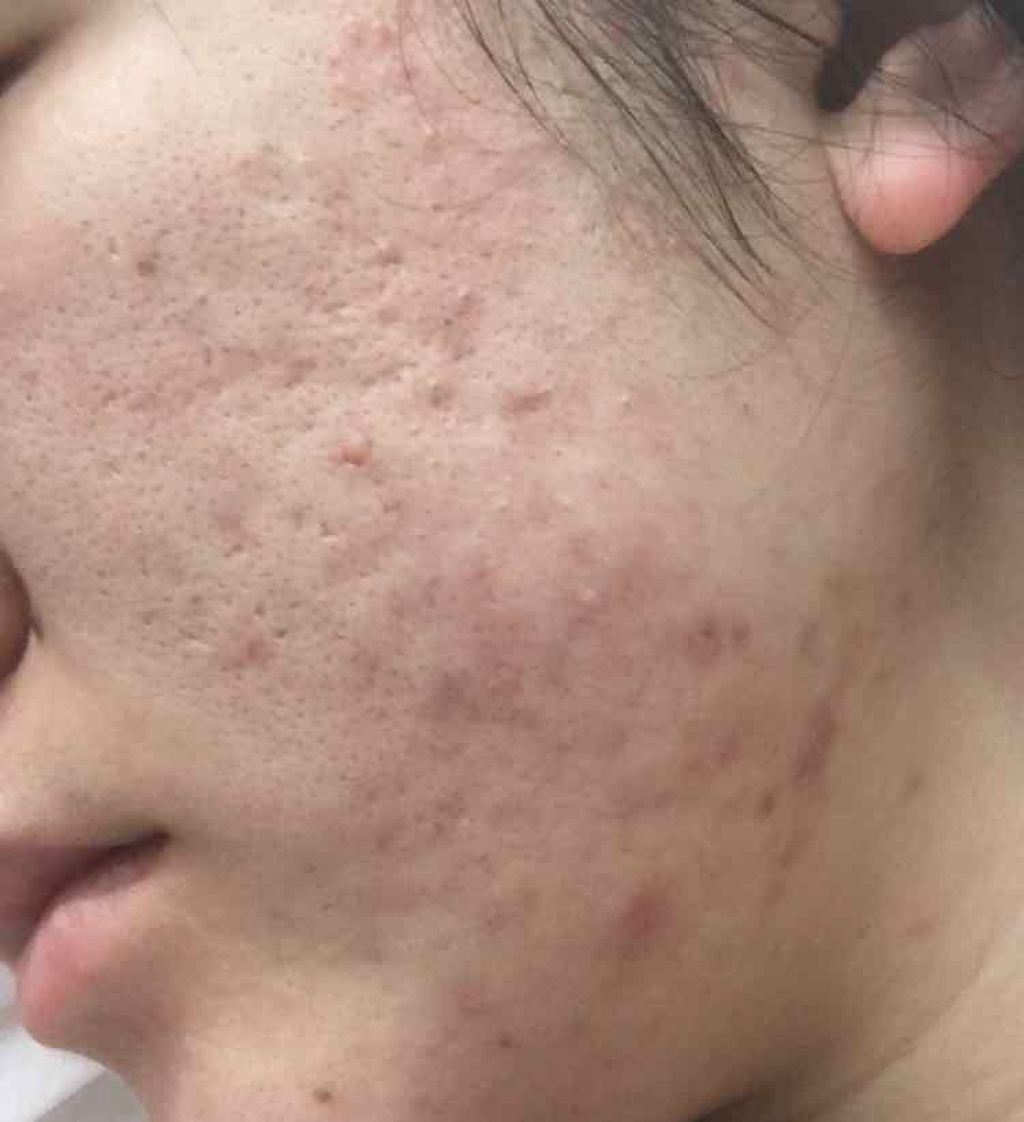 ゆうり on LIPS 「前よりも毛穴良くなったんですがそんなに変わらなかったのでもしお..」(2枚目)