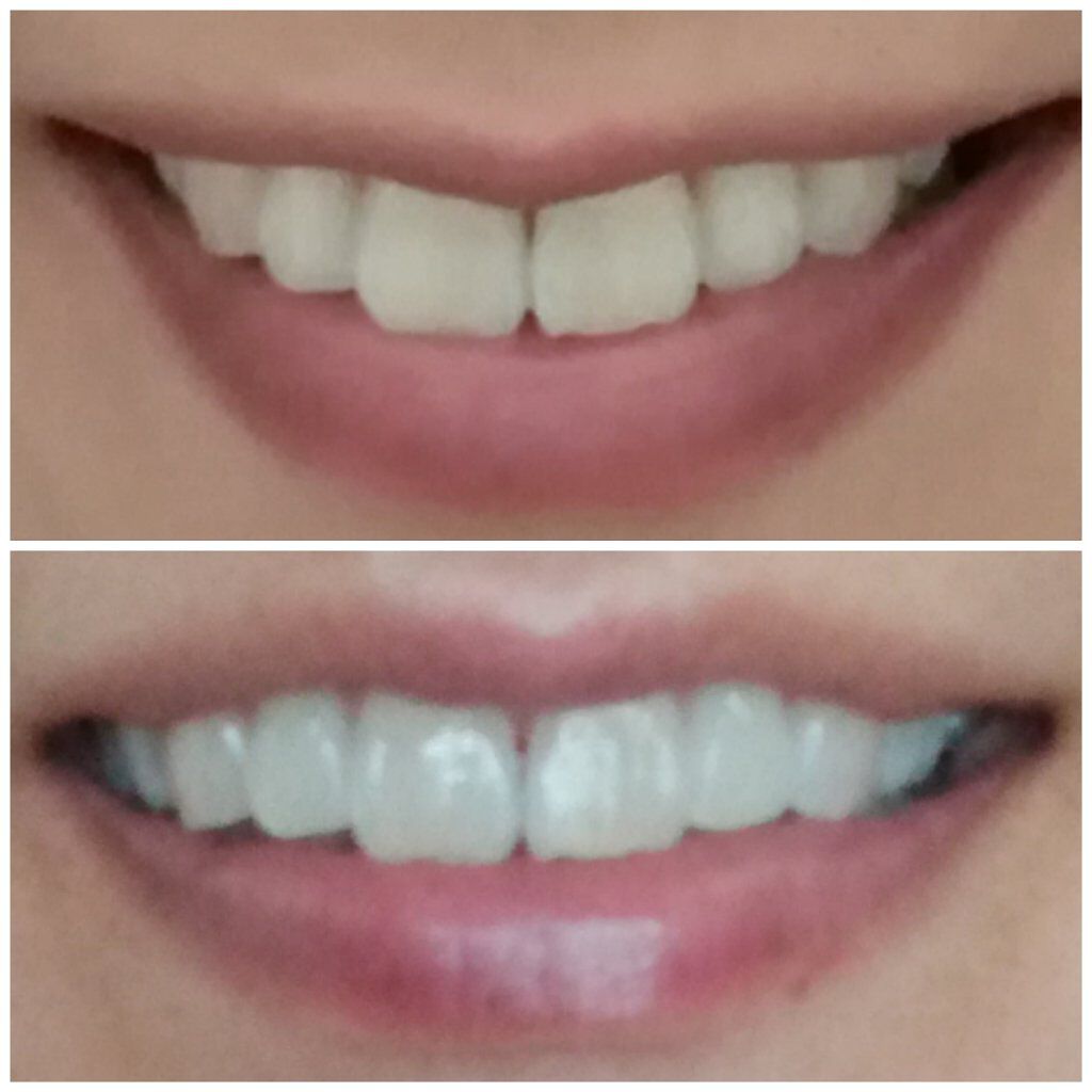 シティースホワイトステインオフケア/シティース/歯磨き粉を使ったクチコミ（2枚目）