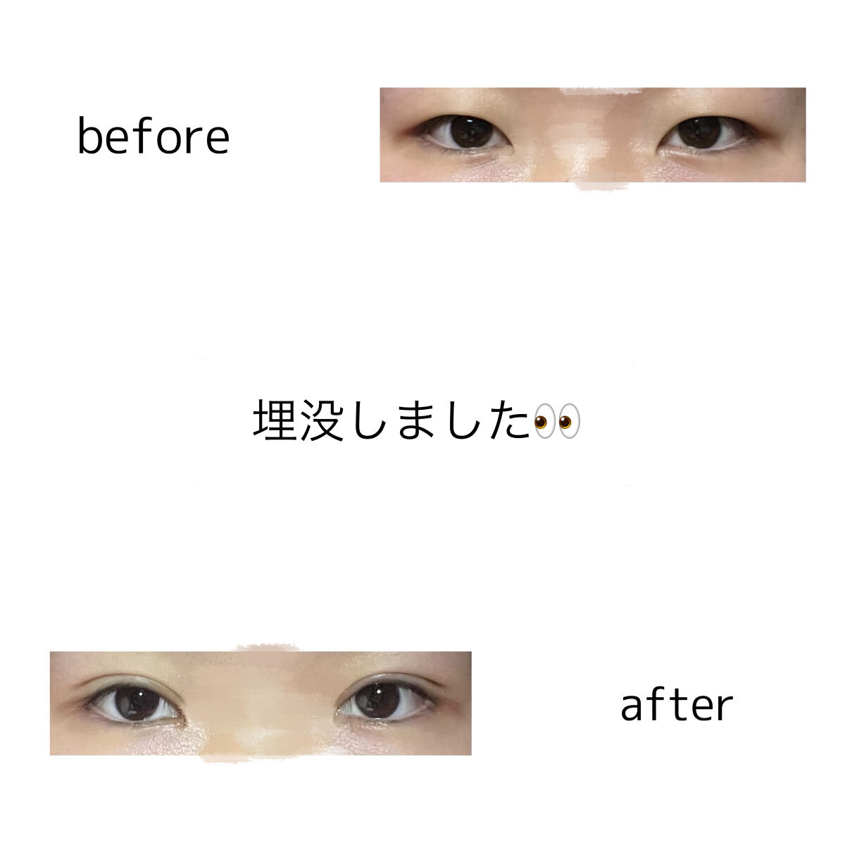 二重整形/その他を使ったクチコミ（1枚目）