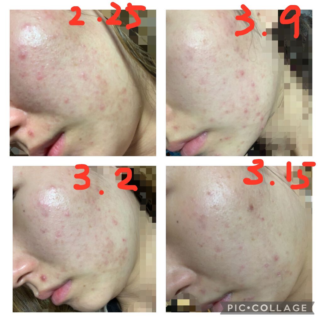 薬用 クリアローション M(しっとりタイプ)/オルビス/化粧水を使ったクチコミ（2枚目）