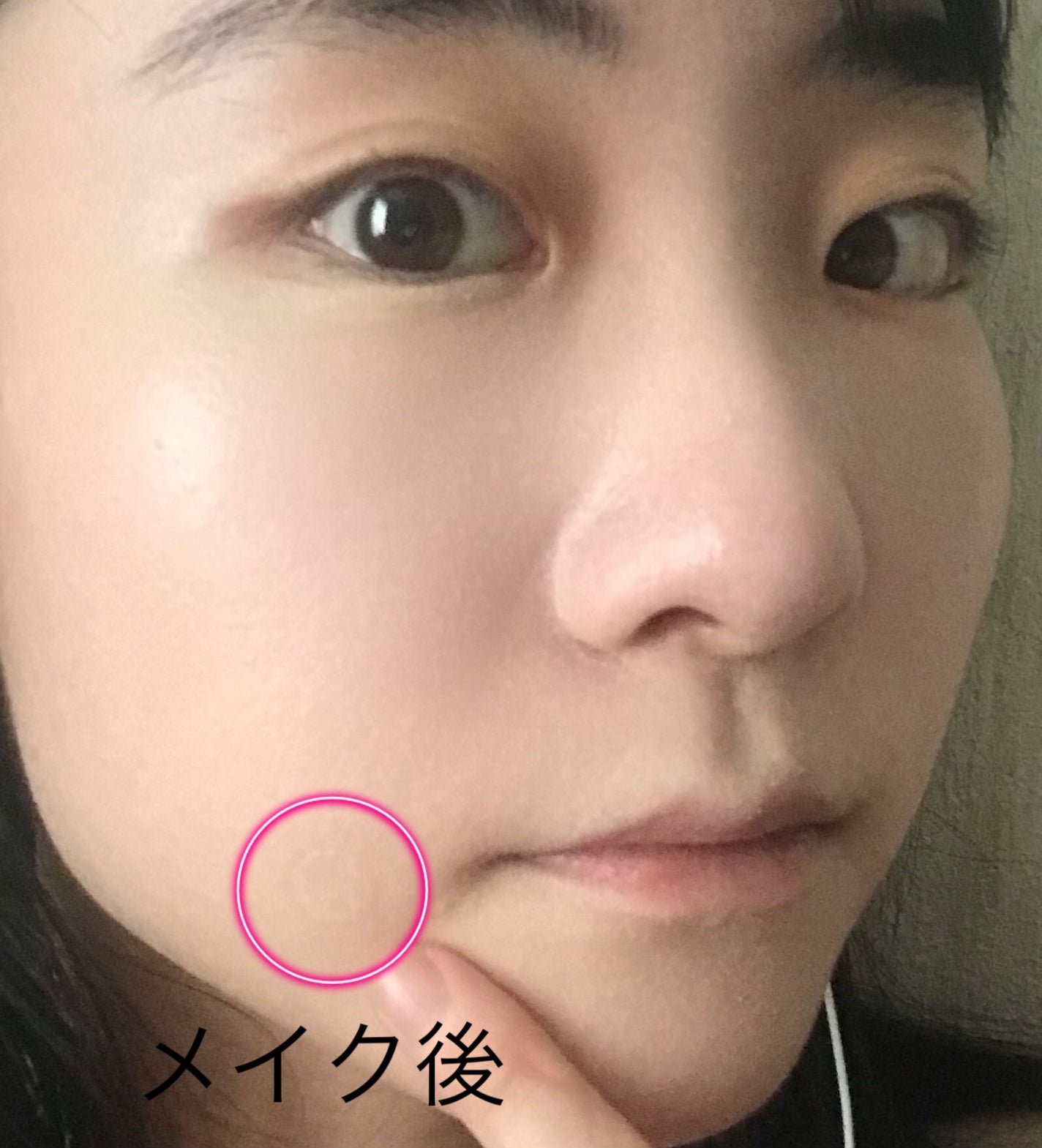 極薄透明パッチ nikipa!/金冠堂/にきびパッチを使ったクチコミ(4枚目)