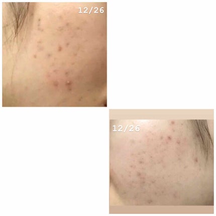 薬用 しみ 集中対策 美容液/メラノCC/美容液を使ったクチコミ(2枚目)