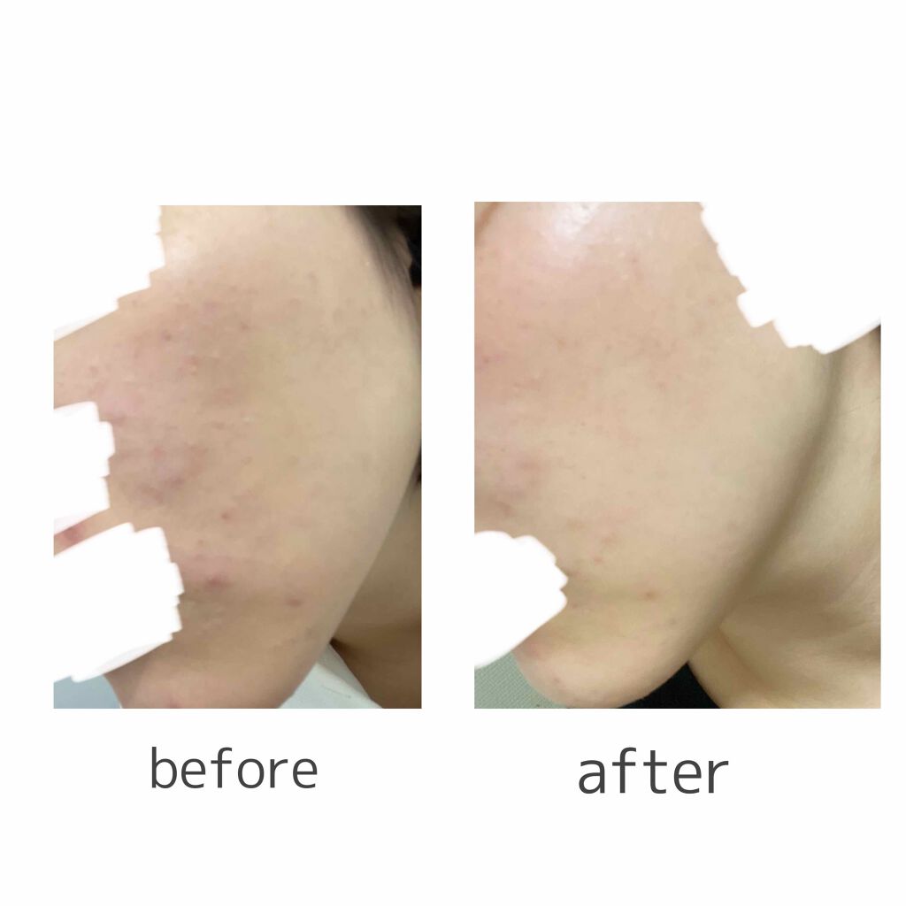 重曹つるつる石鹸/毛穴撫子/ボディ石鹸を使ったクチコミ（1枚目）