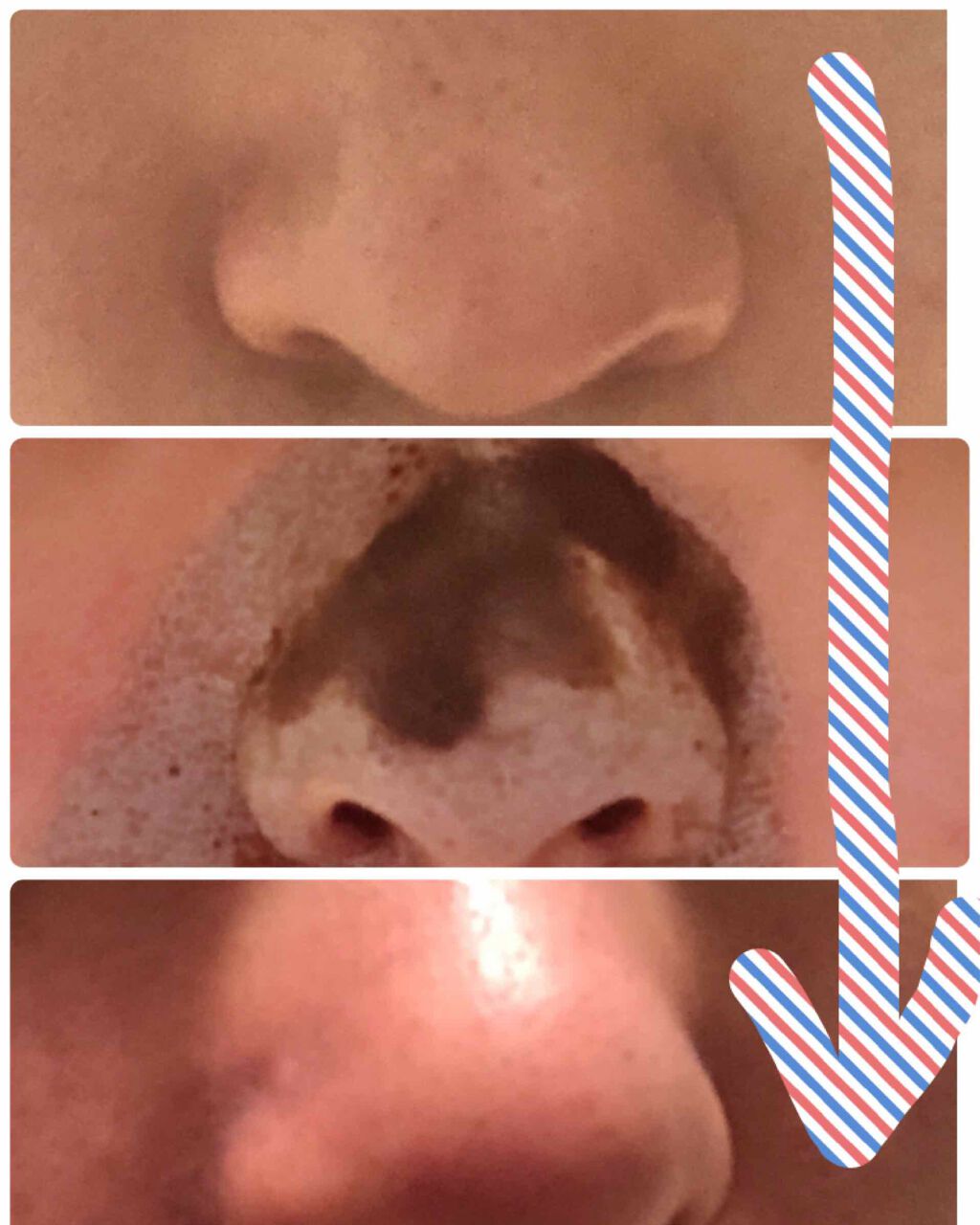 ツルリ 皮脂吸い出し 部分用パック ガスール＆レッドパワー/ツルリ/洗い流すパック・マスクを使ったクチコミ（2枚目）