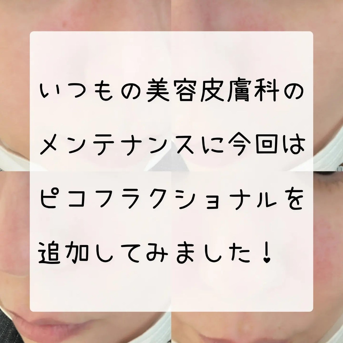 ゆなcc:フォロバ100 on LIPS 「今回は、いつものメンテナンスにピコフラクショナルを追加しました..」(1枚目)