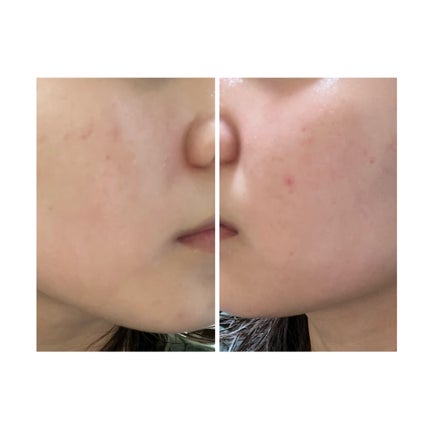 ぽむ on LIPS 「2023.9.13皮膚科に受診 エピデュオとヘパリン処方1枚目..」(2枚目)