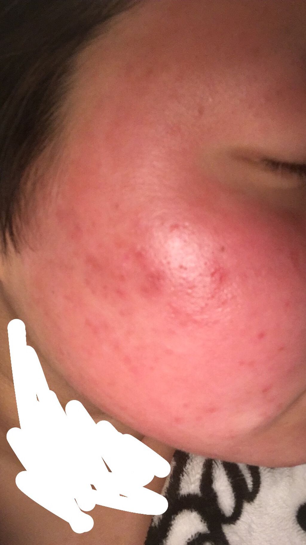 ベピオゲル/マルホ株式会社/その他を使ったクチコミ（1枚目）