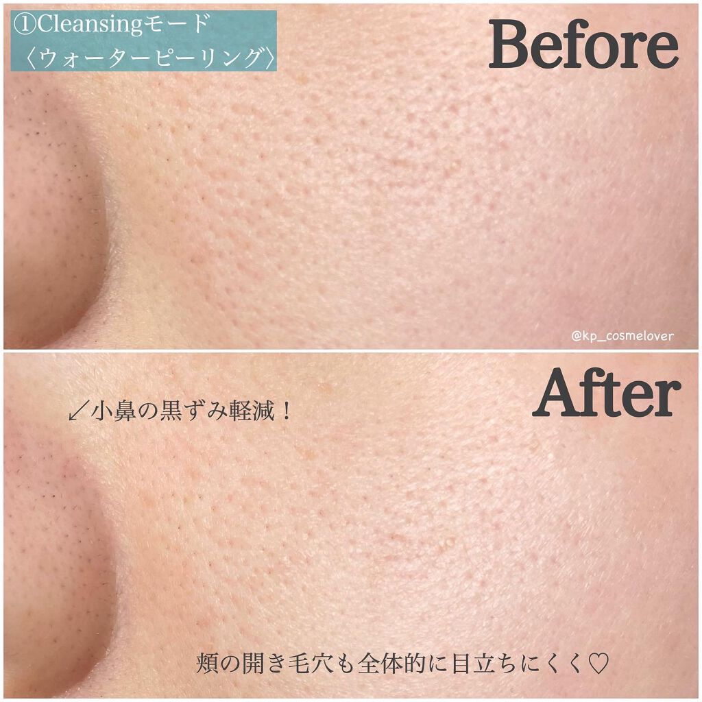 モイスチャーピーリングプロ/Le ment/美顔器・マッサージを使ったクチコミ(5枚目)