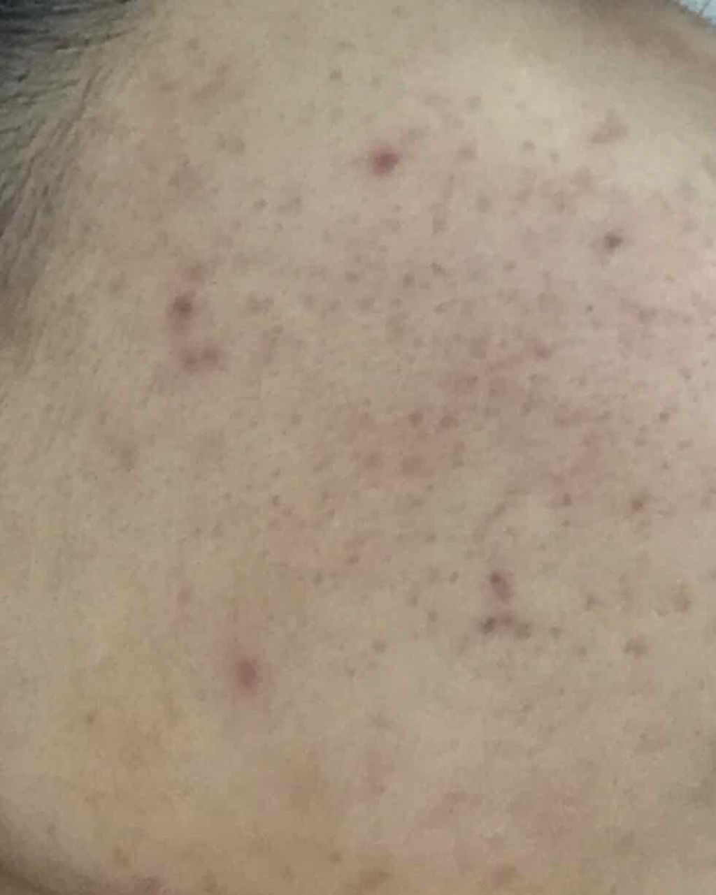 ささみ on LIPS 「!!閲覧注意!!ニキビ肌の写真があります今日から私のニキビ治療..」(3枚目)