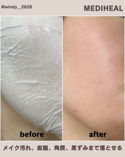 ダーマシナジー ラッピング マスク ポア/MEDIHEAL/シートマスク・パックを使ったクチコミ(4枚目)