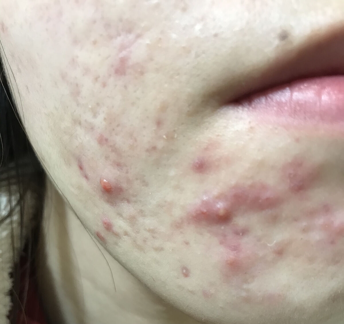 ティーツリーケア ソリューション エッセンシャルマスクEX/MEDIHEAL/シートマスク・パックを使ったクチコミ（3枚目）