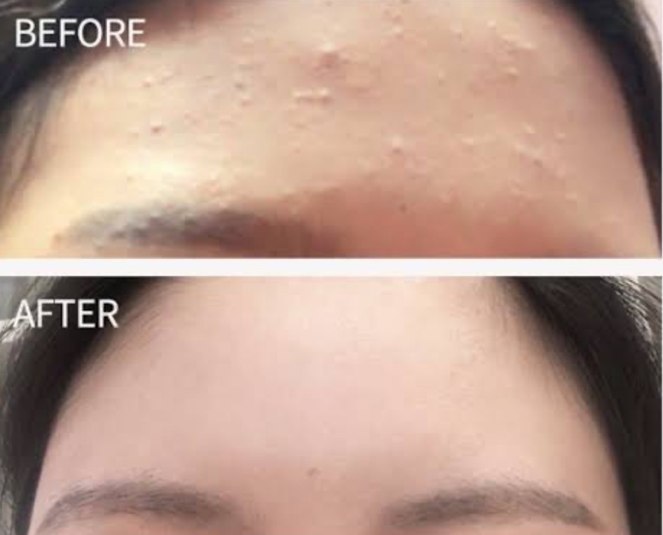 ドクダミ80％スージングアンプル/Anua/美容液を使ったクチコミ（2枚目）